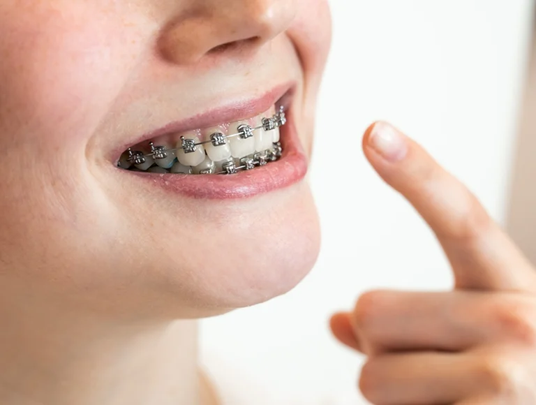 Traditional metal braces Bakersfield