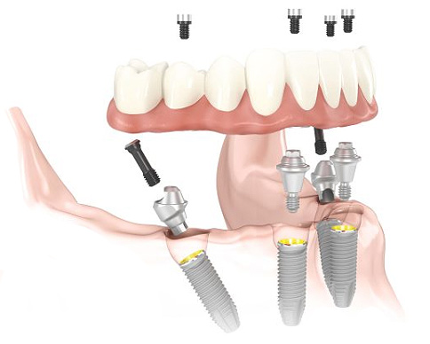 Dentures & Partials